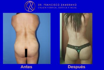 Dr. Francisco Zambrano - Lipoescultura