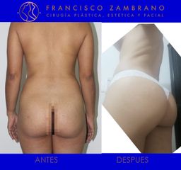 Dr. Francisco Zambrano - Levantamiento de glúteos
