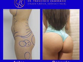 Gluteoplastia - 661623