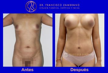Lipectomía - Dr. Francisco Zambrano