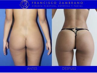 Levantamiento glúteo - Dr. Francisco Zambrano