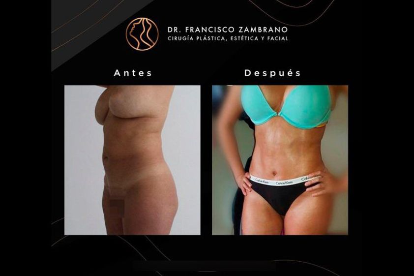Abdominoplastia antes y después - 688181