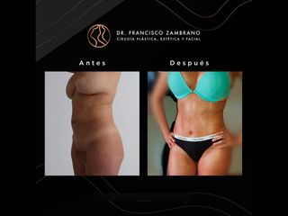 Abdominoplastia - Dr. Francisco Zambrano