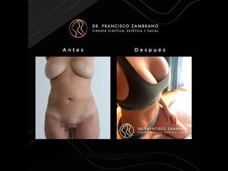Abdominoplastia - Dr. Francisco Zambrano