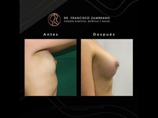 Mamoplastia de aumento - Dr. Francisco Zambrano