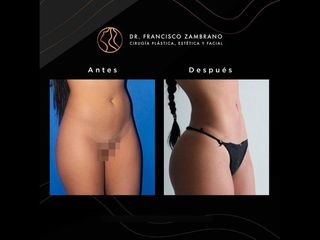 Abdominoplastia - Dr. Francisco Zambrano