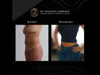 Abdominoplastia - Dr. Francisco Zambrano