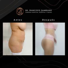 Abdominoplastia - Dr. Francisco Zambrano