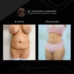 Abdominoplastia - Dr. Francisco Zambrano