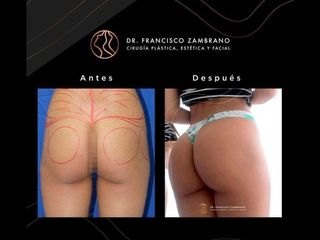 Gluteoplastia - Dr. Francisco Zambrano