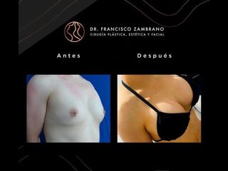 Mamoplastia de aumento - Dr. Francisco Zambrano