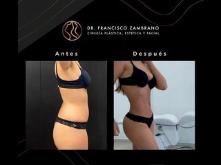 Liposucción - Dr. Francisco Zambrano