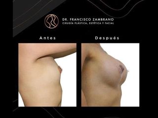 Mamoplastia de aumento - Dr. Francisco Zambrano