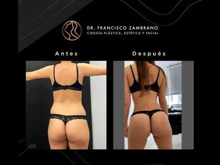 Lipoescultura - Dr. Francisco Zambrano