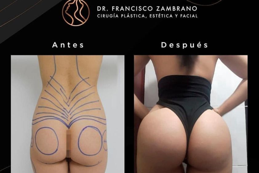 Gluteoplastia antes y después - 738384