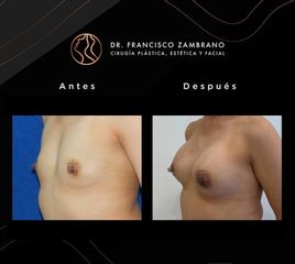 Mamoplastia de aumento - Dr. Francisco Zambrano