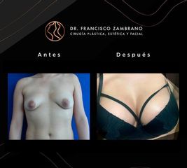 Mamoplastia de aumento - Dr. Francisco Zambrano