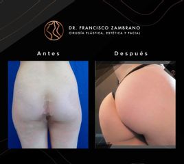 Gluteoplastia - Dr. Francisco Zambrano