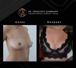 Levantamiento de senos - Dr. Francisco Zambrano