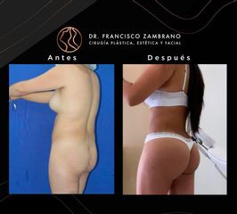 Lipoescultura - Dr. Francisco Zambrano