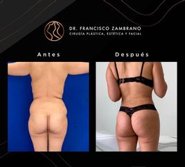 Liposucción - Dr. Francisco Zambrano