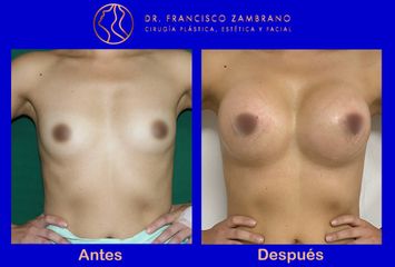 Mamoplastia de aumento - Dr. Francisco Zambrano