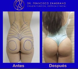 Levantamiento de glúteos - Dr. Francisco Zambrano