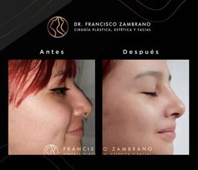 Rinoplastia - Dr. Francisco Zambrano