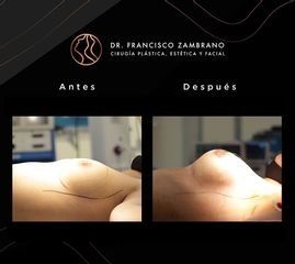 Mamoplastia de aumento - Dr. Francisco Zambrano