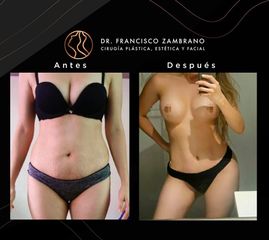 Abdominoplastia - Dr. Francisco Zambrano