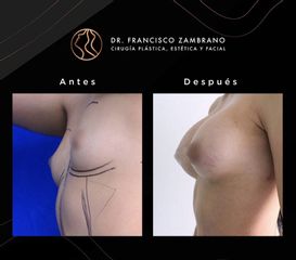 Mamoplastia de aumento - Dr. Francisco Zambrano