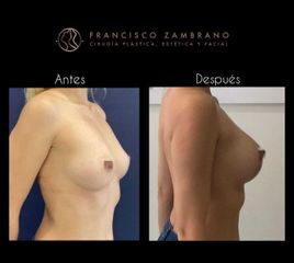 Mamoplastia de aumento - Dr. Francisco Zambrano