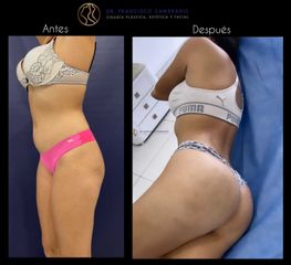 Gluteoplastia - Dr. Francisco Zambrano