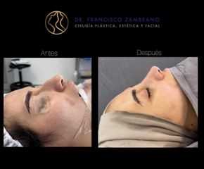Rinoplastia - Dr. Francisco Zambrano