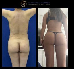 Liposucción - Dr. Francisco Zambrano