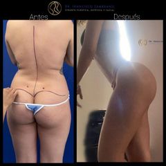 Liposucción  -Dr. Francisco Zambrano