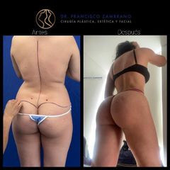 Liposucción - Dr. Francisco Zambrano