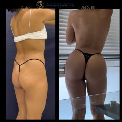 Liposucción - Dr. Francisco Zambrano
