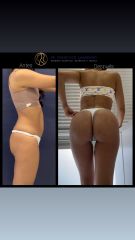 Liposucción - Dr. Francisco Zambrano