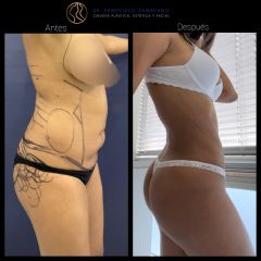Liposucción - Dr. Francisco Zambrano