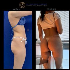 Liposuccion - Dr. Francisco Zambrano