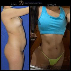 Liposucción - Dr. Francisco Zambrano