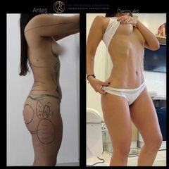 Liposucción - Dr. Francisco Zambrano