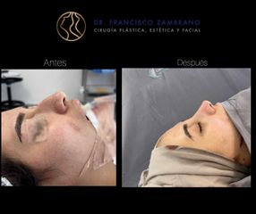 Rinoplastia - Dr. Francisco Zambrano