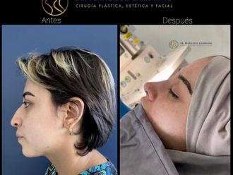 Rinoplastia - 823276