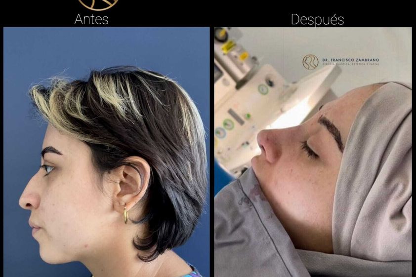 Rinoplastia antes y después - 823276