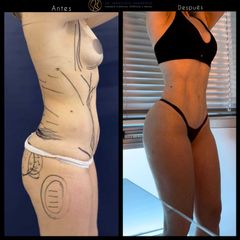 Liposucción - Dr. Francisco Zambrano