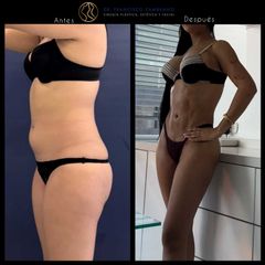 Liposucción - Dr. Francisco Zambrano