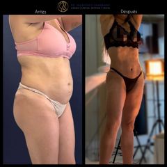 Liposucción - Dr. Francisco Zambrano