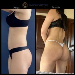 Gluteoplastia - Dr. Francisco Zambrano